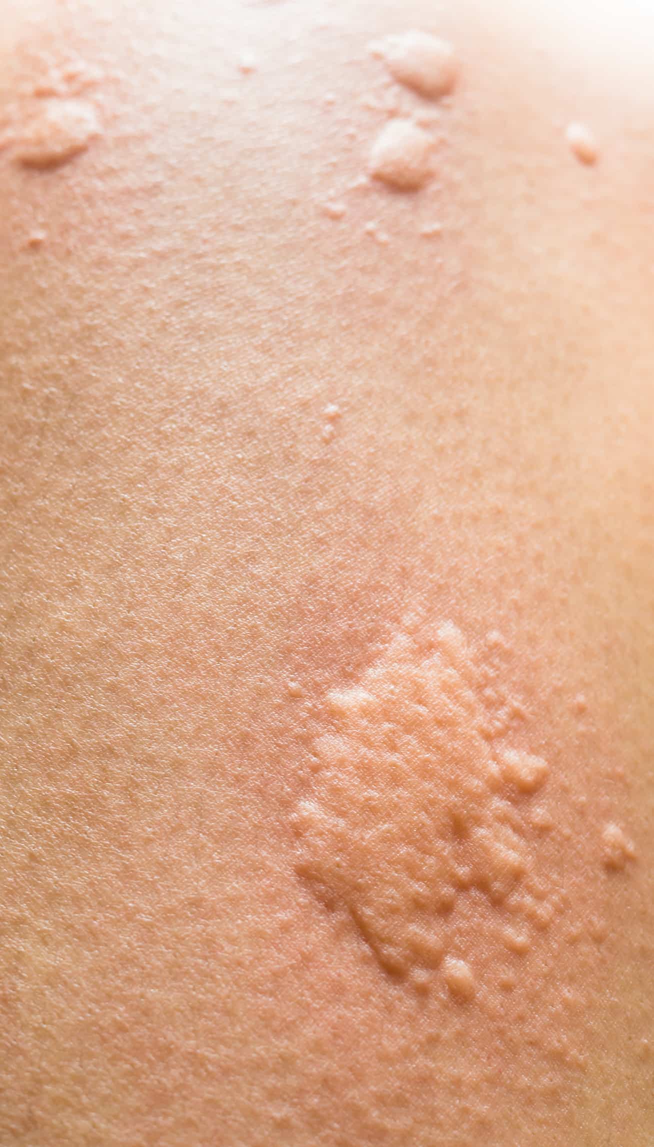 pest-allergies_raised_red_swollen_skin-hives