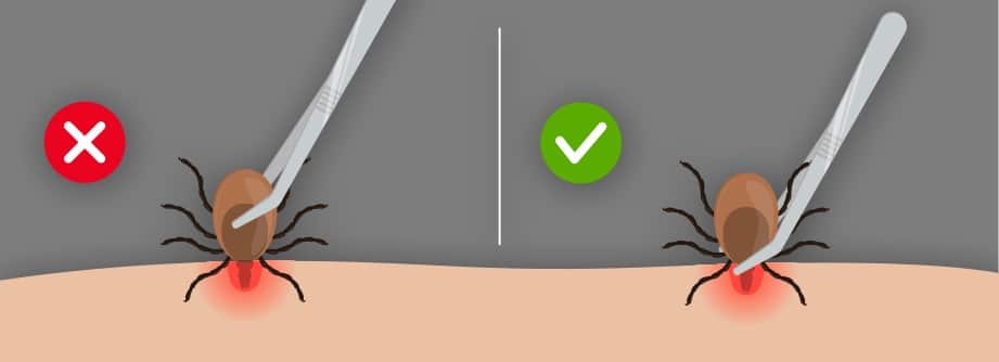 The proper way to remove a tick.