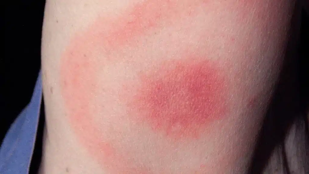 Rash from ehrlichiosis, a tick-borne illness common in Tennessee.