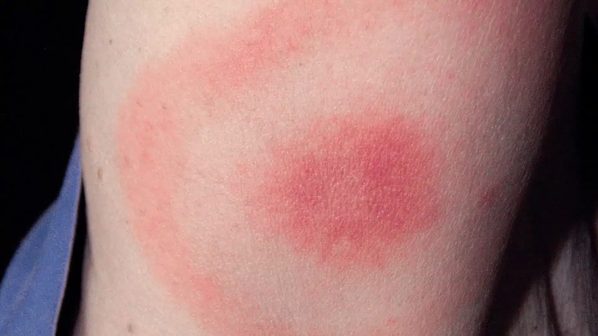 Rash from ehrlichiosis, a tick-borne illness common in Tennessee.
