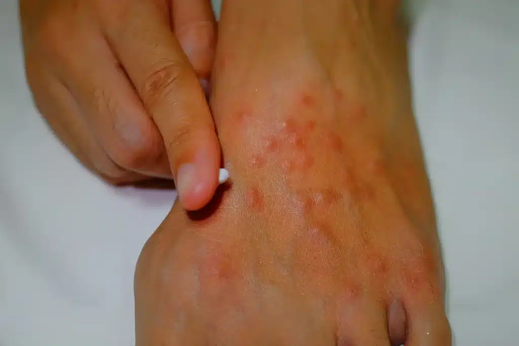 Fire ant sting showing blister and pustule formation on skin