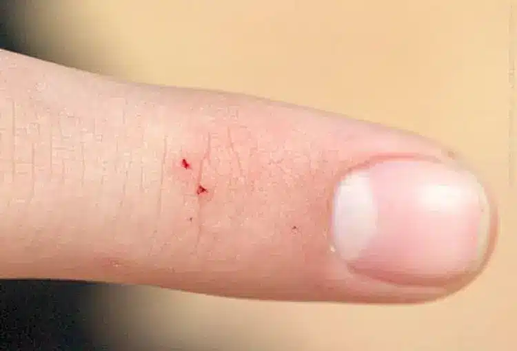 Are Black Widow Spiders Common in Middle Tennessee? 5 spider bite on a human finger
